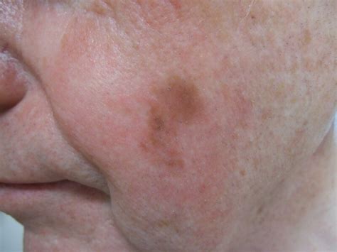 age spot or melanoma pictures
